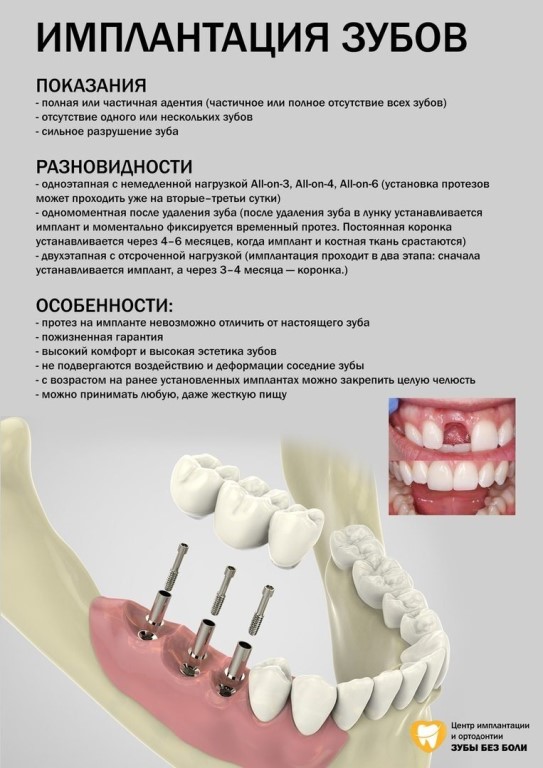 Верхние импланты зубов как выглядят Верхние импланты зубов как выглядят