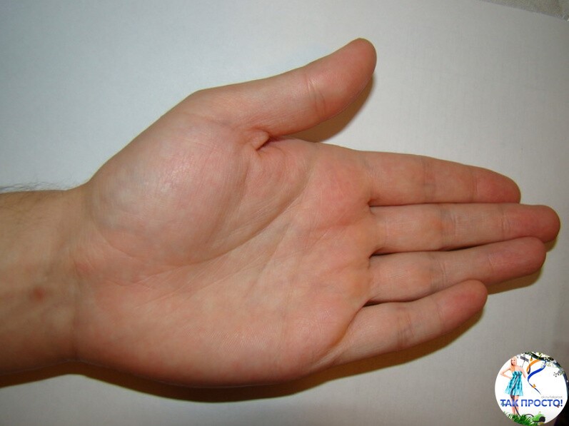 Ладони при циррозе печени фото как выглядят Ладони при циррозе печени фото как выглядят